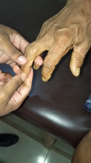 Positive Hoffman test
