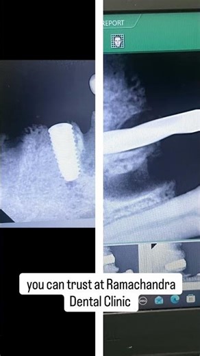 Root piece extraction followed by implant placement with bone grafting