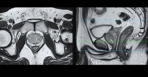 Mri Prostate Gland Revealing Enlarged Size Stock Footage Video (100% Royalty-free) 3476695501 | Shutterstock