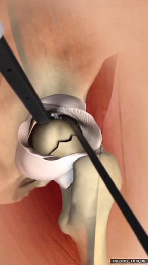 First Choice Health Care on Instagram: "A hip replacement operation with the aid of Medtronic's Aquamantys electrosurgical device. Aquamantys is a RF bipolar sealer that is used for hemostatic sealing and coagulation of soft tissue. The sealer provides significantly less blood loss, better visualization of surgical site, and less operating room time for certain @first_choice_health_care @first_choice_health_care @first_choice_health_care @first_choice_health_care @first_choice_health_care ......