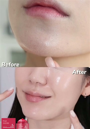 Capsule cream hydrates deeply and helps balance uneven tone and rough texture. #UnevenSkin #WinterSkincare #KoreanSkincare #BeautyTok #FYP