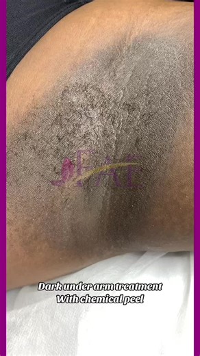 Dark Underarm Treatment: Chemical Peel Before & After