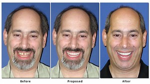 Cosmetic Dental Smile Simulations - Try A Free Case