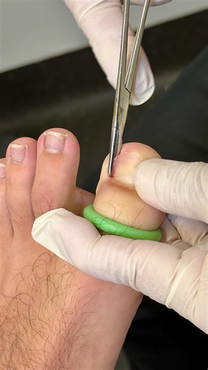 footinjuryclinic | Today's procedure: Partial Nail Avulsion (PNA) Only the problematic nail edge is removed, preserving the healthy nail while providing a... | Instagram