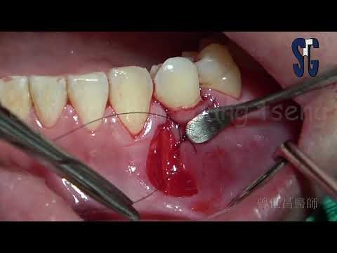 Lateral Pedicle Flap ( LPF) with xenogenic graft