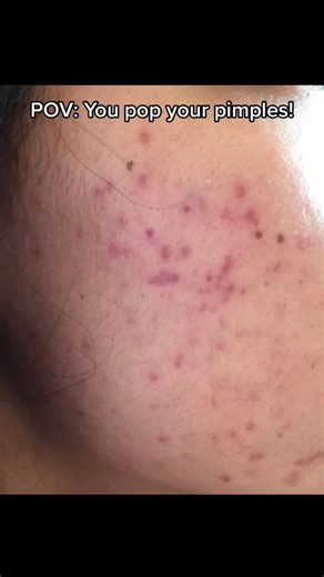 Popping pimples cause the pimple to become more red, inflamed, swollen and infected, and leads to scarring. Also it can spread the bacteria and lead to more pimples! Instead use pimple patches✅ #poppingpimple #acne #acnescar #pimplepop | Dr. Farzan
