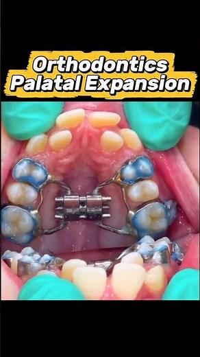 Turning the Palatal Expander Key! 🔑🤯 #braces #orthodontics #palatalexpansion #dentist