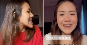 'Scariest thing I've ever gone through': Singapore woman shares $26,000 jaw surgery experience on TikTok
