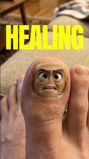 You Fixed Your Cracked Screen But Ignored This? Nail Fungus Explained | Orivelle Anti Fungal Pen