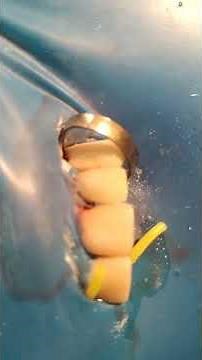 Direct restoration on implant 22.ICX-Active 3.75-12.5.immediate load.