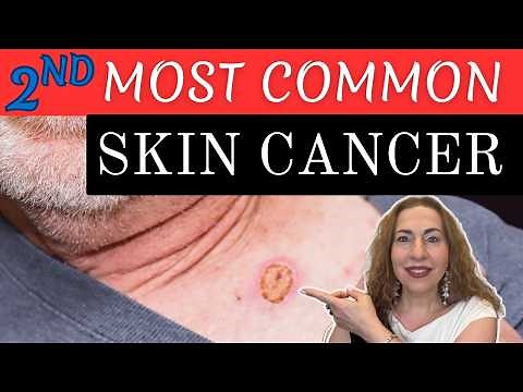 2nd Most Common Skin Cancer: Squamous Cell Carcinoma: Who, Why & What to DO!
