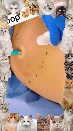 Understanding Cyst Popping: Techniques and Tips