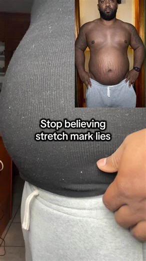 Stop Believing Stretch Mark Myths: Real Results Matter