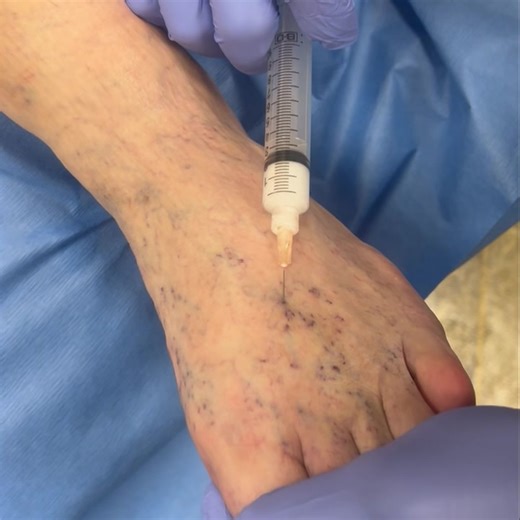 Polidocanol is a widely used sclerosing agent for sclerotherapy due to its favorable properties. Here are three reasons to use it: 1. Safety and Efficacy: Polidocanol is highly effective at collapsing and obliterating targeted veins, particularly small to medium-sized varicose and spider veins, with a low risk of serious complications when used correctly. It causes endothelial damage, leading to thrombosis and eventual fibrosis of the vein. 2. Minimal Pain and Discomfort: Polidocanol has a local