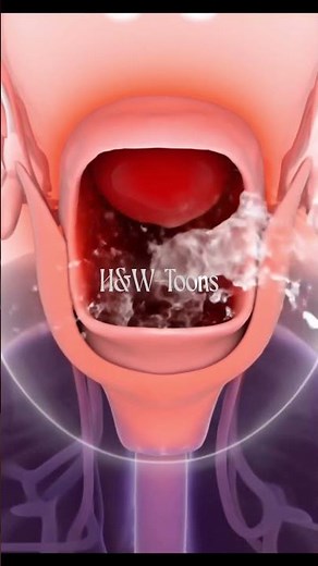 EPIGLOTTITIS: The Airway's Swift Strangulation #HealthAwareness #3DMedicalAnimation #MedFacts #rn