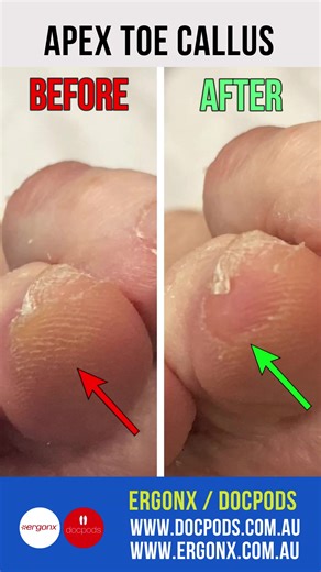 Expert Podiatrist Removes Toe Callus | Foot Care Specialist in Action
