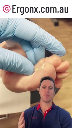 Say Goodbye to Painful Callus & Corn Between Toes Expert Tips & Solutions #FootCare #HealthyFeet