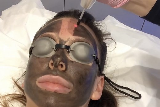 Laser Carbon Facial Treatment - What to expect - The Beauty Editor