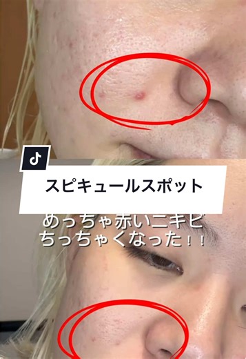 ニキビケアの新習慣！オブセロとエーキュアスピキュール