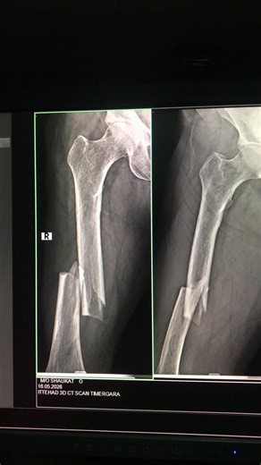 AP/Lateral X-ray of Femur Fracture