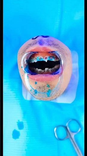 Mr Kiwi finally gets braces! 😱🤯