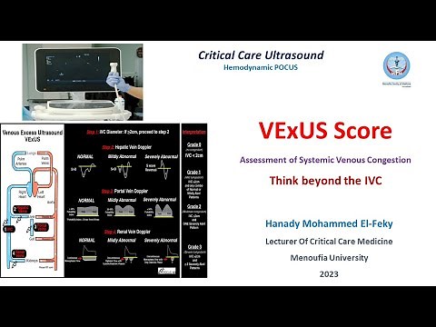 VExUS Score (How to assess Organ congestion)