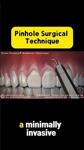 👀Immediate Results After Pinhole® Surgical Technique — No Scalpel, No Stitches!