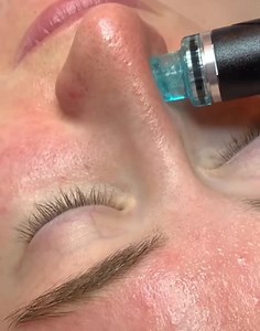 Results that speak for themselves  • • • #hydrafacial #hydrafacialtreatment | Zeeman's | Facebook