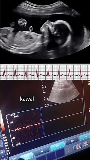 This is what a baby heart beat sound like during an ultrasound #ultrasound #shorts #natal