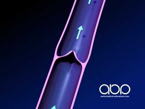 Leg Vein Valve - Normal - 3D Medical Animation || ABP ©
