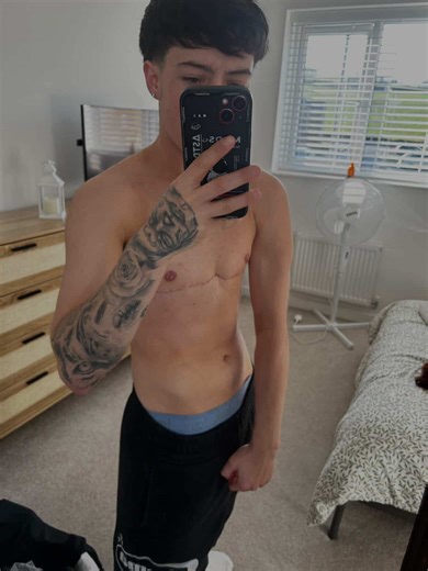 Two months post-op and thriving! Procedure: Bilateral mastectomy with free nipple graft Surgeons: Chloe Wright & Kate Williams