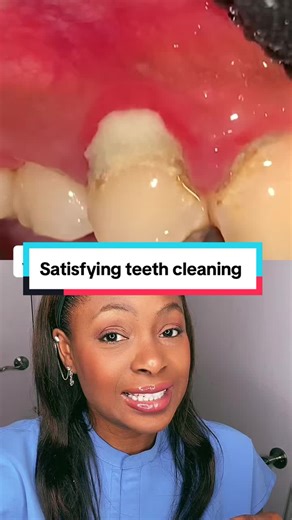 Satisfying Teeth Cleaning with Cavetron at the Dentist