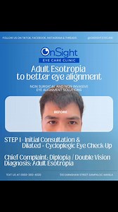 5 comments | Strabismus with diplopia non surgical and non invasive...