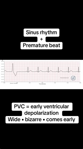 This is sinus rhythm with ventricular ectopy (PVCs) 👀 Ectopy means early beats coming from outside the SA node — not every PVC is an emergency. What to assess FIRST: Is the patient symptomatic? Chest pain, hypotension, dizziness, SOB? Is the ectopy frequent or new? Electrolytes, hypoxia, ischemia, stimulants? Most isolated PVCs in a stable patient = observe and correct the cause. PVCs become concerning when they are: • Frequent • Multifocal • Runs of VT • Associated with symptoms Context is eve