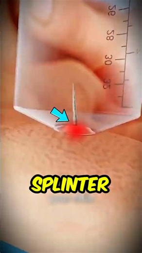 If You Ever Get a Splinter, DON’T Use Tweezers… Try This Instead❗👍