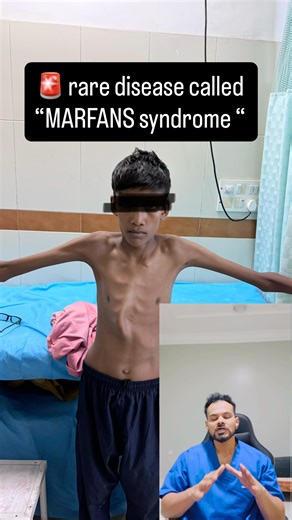 Obaidur Rahman on Instagram: "Marfan Syndrome. A genetic disorder that quietly stretches the body — and sometimes tears it from within. It affects the connective tissue, the biological “glue” that gives strength and structure to our organs. In Marfan’s, this glue is weak — leading to changes across the body. Most patients are tall and thin, with unusually long arms, legs, fingers, and toes — a condition known as dolichostenomelia. The chest may be sunken (pectus excavatum) or protruding (pectus 