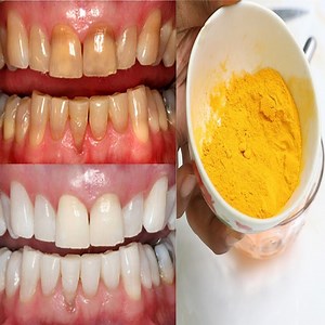9.3K views · 555 reactions | Add turmeric powder, baking soda, and coconut oil together, mix and apply on your teeth. The taste might be unpleasant for many, but its continuous use will give whiter teeth and remove stains. You can use a brush to scrub the solution on your teeth for few minutes and then spit and rinse with water. | Health Zone | Facebook