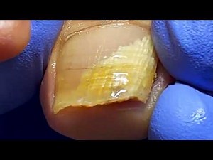 Instant Pain Relief! Professionally Treating a Severe, Yellowing Fungus Nail