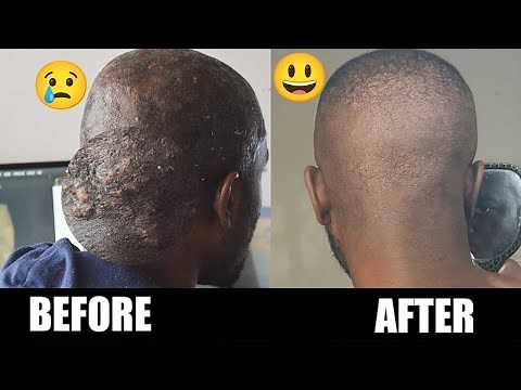 Treating bumps at the back of your head - Acne Keloidalis Nuchae (AKN)