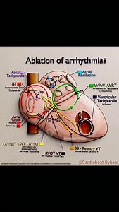Arrhythmia Ablation Targets ⚡ #Cardiology #Electrophysiology #Ablation #Arrhythmia #AVNRT AtrialFibrillation | Abdallah Othman