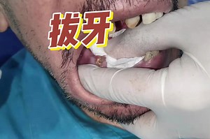【操作】拔牙