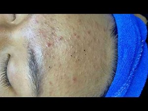 The Complete Guide to Treating Blackheads Safely