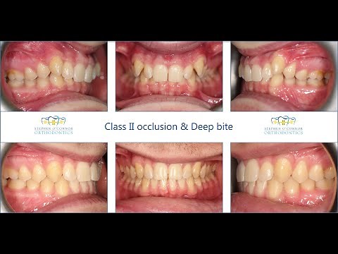 Class II occlusion - Carriere appliance & Labial fixed braces