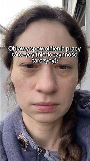 Jakie objawy daje niedoczynność tarczycy? #shorts