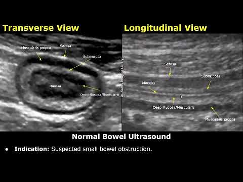 Small Bowel Ultrasound Reporting | How To Write USG Report | Bowel Obstruction, Crohn's Disease