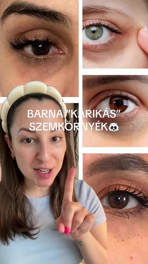 Hiperpigmentációt csökkentő szemránckrém