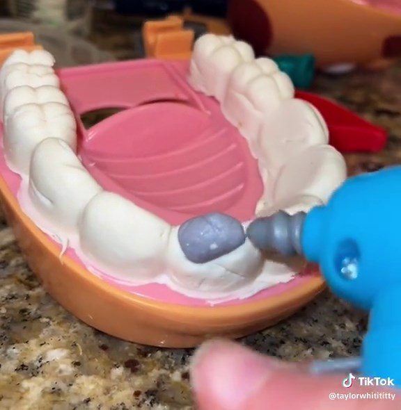 3 surface anterior amalgam filling replacement using BL-XL composite. incisive nerve block anesthetic administered using 0.5 carpule of carbocaine 3% and 0.5 carpule articaine 4%, 1:100,000. Fractures: moderate, severe Decay: recurrent Materials: Etch, PQ1, composite Pt tolerated tx well