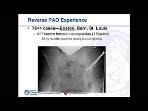 True reverse PAO: Experience with acetabular realignment beyond simple retroversion / M. Millis