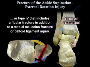 Ankle fracture , Supination External Rotation - Everything You Need To Know - Dr. Nabil Ebraheim