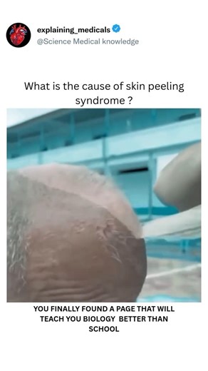 What is the cause of skin peeling syndrome 😷🩺#trending #skincare #viral #pharmcology #doctorlife